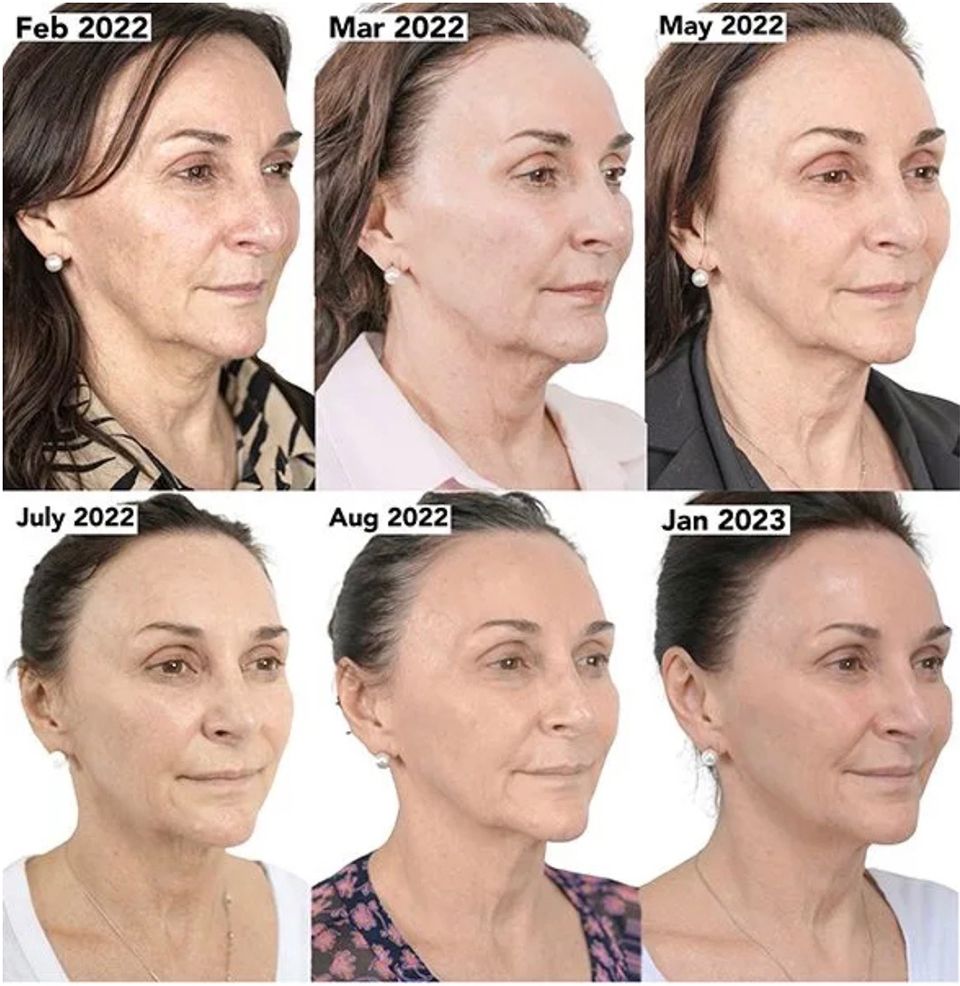 Shirley Ballas - year-long Neogen Plasma treatment results