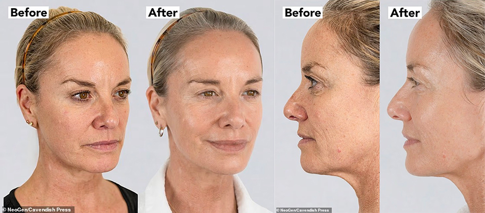 Tamzin Outhwaite - feels so confident - after she reveals her amazing Neogen Plasma treatment results